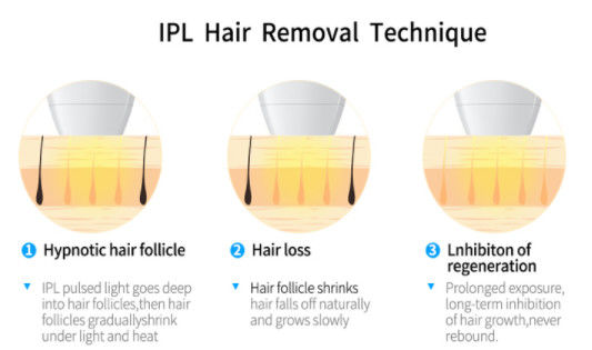 2000w лазерная техника ДИОДА OPT IPL+ 808NM для оборудования удаления волос